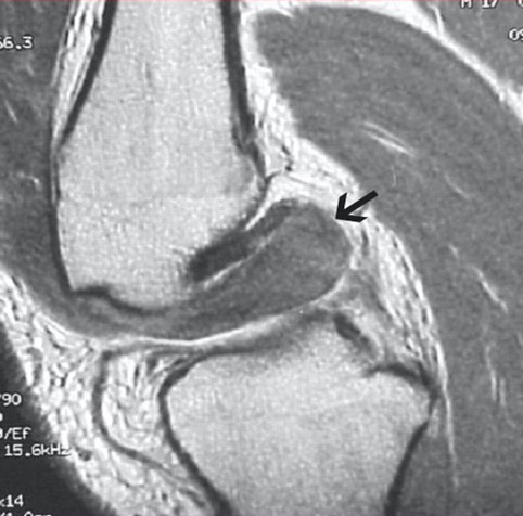 Irreducible knee MRI 2
